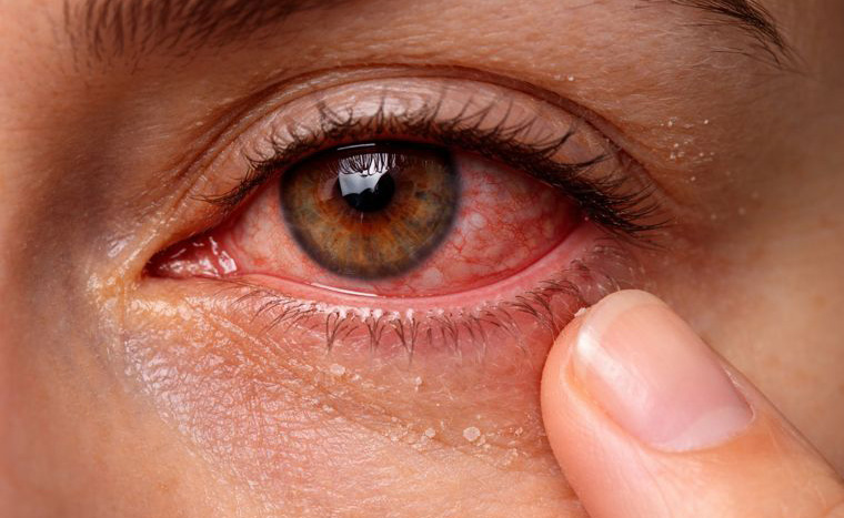 Emergency Eye Care in Stratford, CT